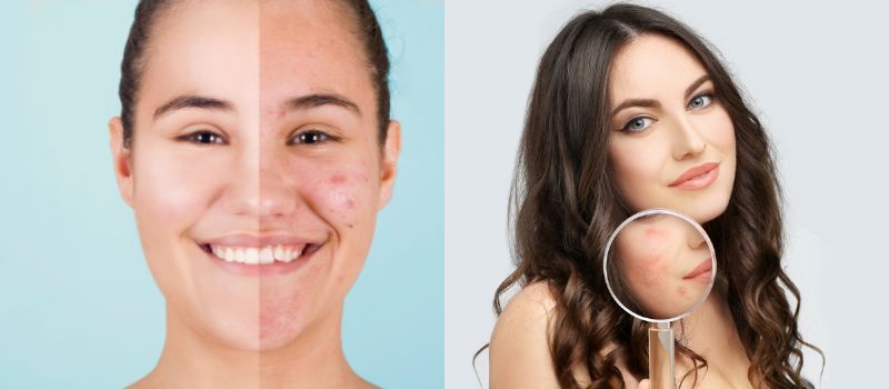 A side-by-side comparison of a person's skin before and after using oil free acne wash.