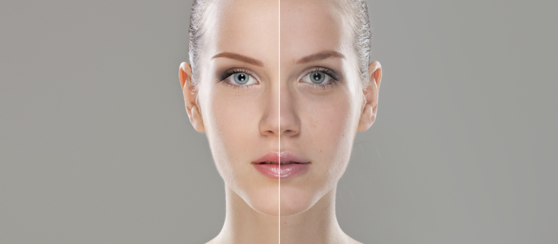 A woman's face showcasing the transformation before and after skin whitening treatment with Gluta White Capsules.