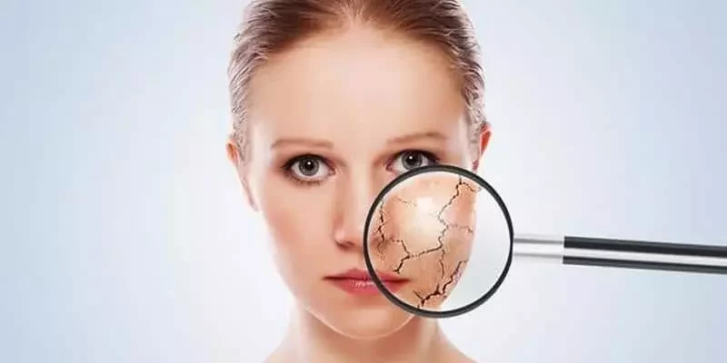 girl has dry skin