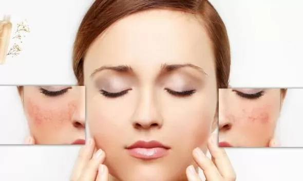 A woman with acne on her face, highlighting the importance of antioxidants for skin health and rejuvenation.