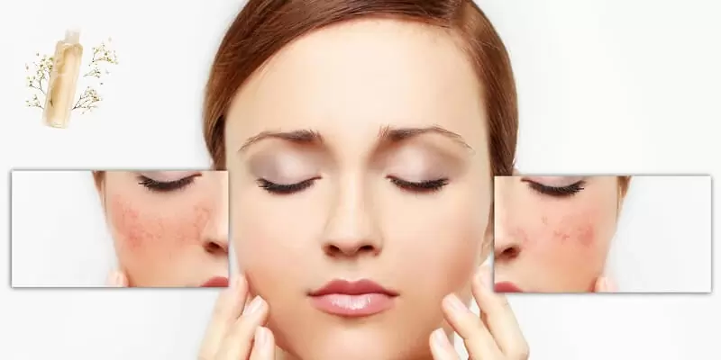 A woman with acne on her face, highlighting the importance of antioxidants for skin health and rejuvenation.